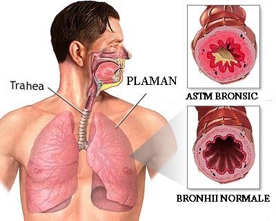 Astmul bronsic - tratamentul crizei de astm